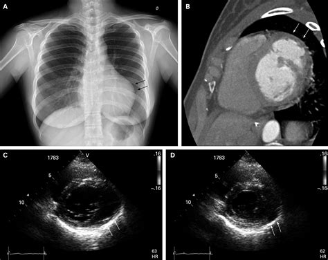 lv diverticulum